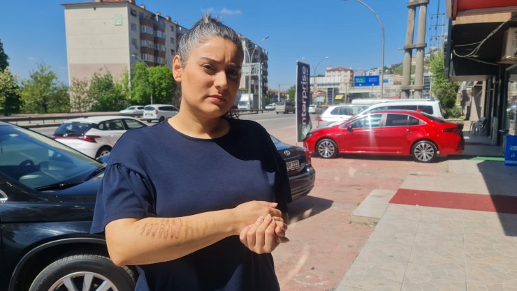 Epilasyon için gittiği güzellik merkezinde kolları yandı