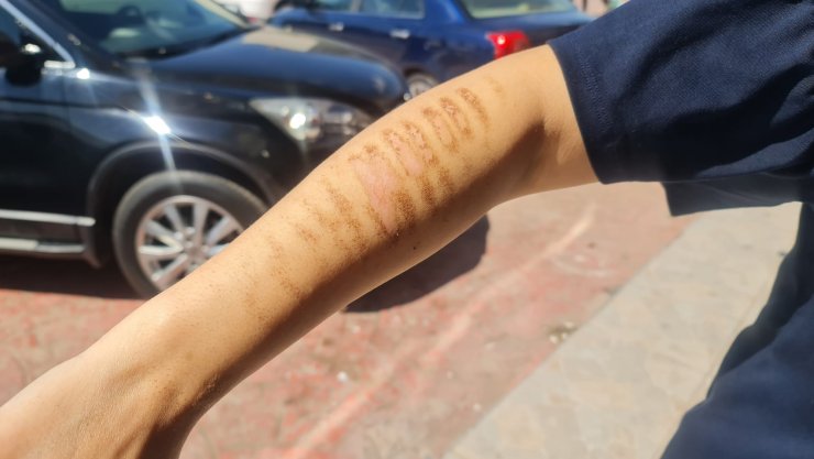 Epilasyon için gittiği güzellik merkezinde kolları yandı