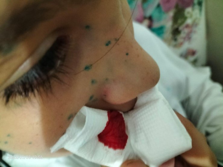 Okulda 4 arkadaşının dövdüğü Ali Emir'in boynu kırıldı