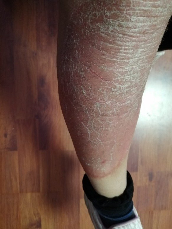 Egzama tedavisinde umut veren gelişme