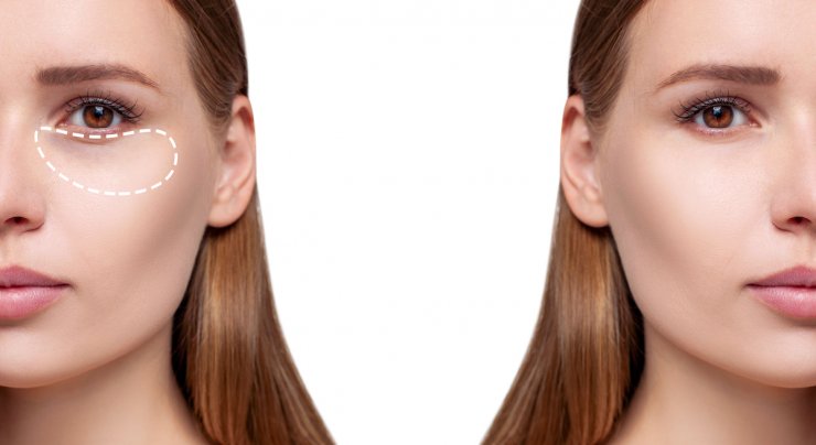 Uzmanı uyardı: Gözaltındaki mor halkalar basit bir cilt problemi olmayabilir