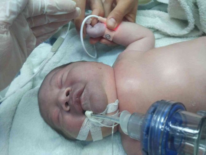 Yeni doğan bebeğin köprücük kemiği kırıldı, vücudu mosmor oldu