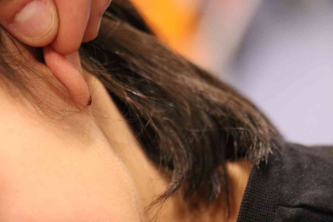 Kulağına kene yapışan küçük çocuk hastaneye kaldırıldı