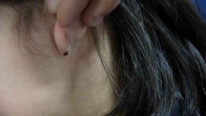 Kulağına kene yapışan küçük çocuk hastaneye kaldırıldı