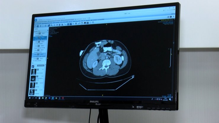 Karnında 40 santimetrelik fıtıkla yaşıyordu