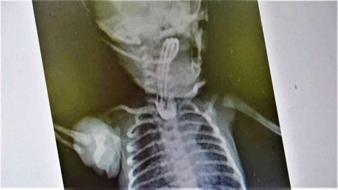 Yemek borusu olmadan doğan bebeğe doktordan hayati dokunuş