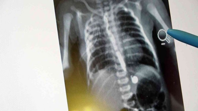 Yemek borusu olmadan doğan bebeğe doktordan hayati dokunuş