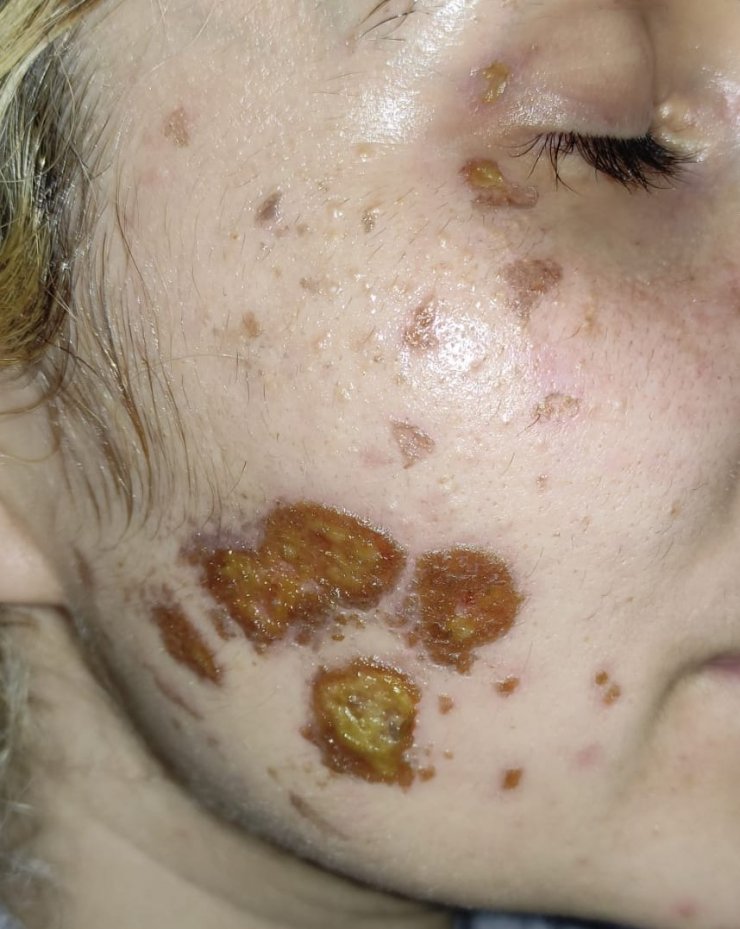 Kimyasal atılan Sultan'ın yüzündeki yaralar sabit iz niteliğinde