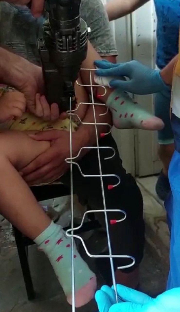 Bacağına saplanan askıyı itfaiye kesti