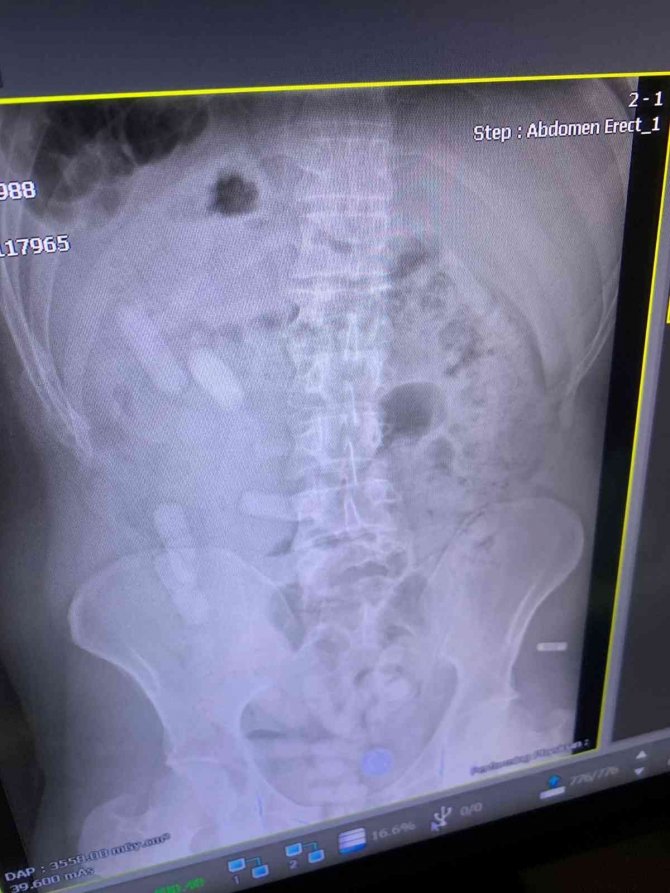 Midesinden 15 paket uyuşturucu çıktı