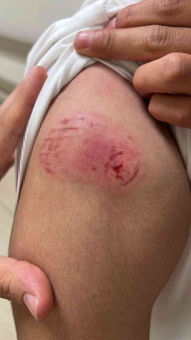 Akıl almaz kavga kamerada: Alçılı kolla ve falçatayla saldırıp, kulağından ısırdı