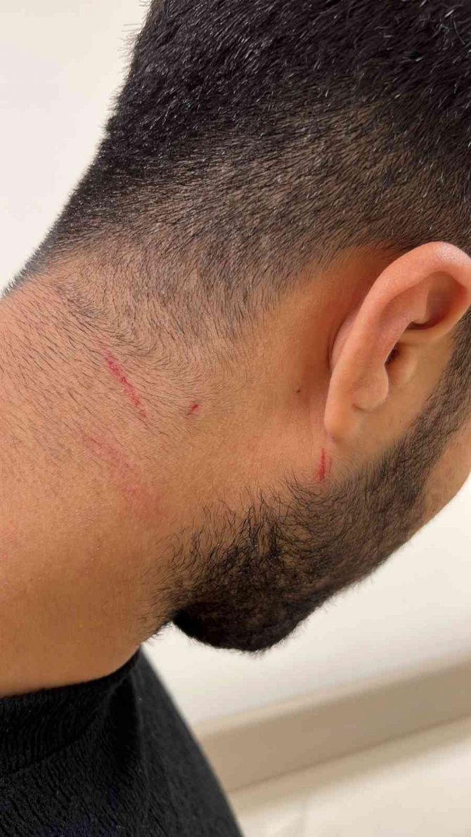 Akıl almaz kavga kamerada: Alçılı kolla ve falçatayla saldırıp, kulağından ısırdı