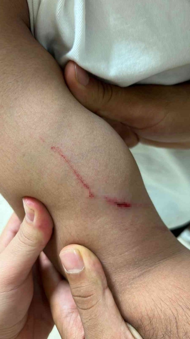 Akıl almaz kavga kamerada: Alçılı kolla ve falçatayla saldırıp, kulağından ısırdı