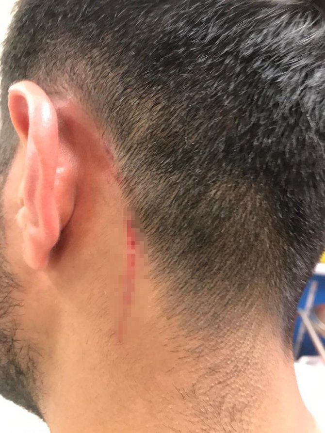 Akıl almaz kavga kamerada: Alçılı kolla ve falçatayla saldırıp, kulağından ısırdı