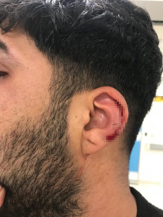 Akıl almaz kavga kamerada: Alçılı kolla ve falçatayla saldırıp, kulağından ısırdı