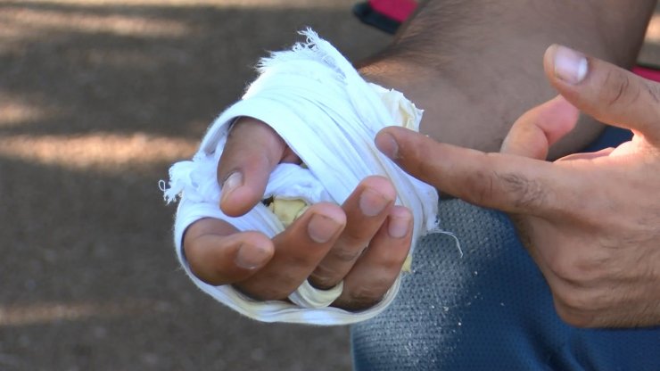 Asker uğurlamasında elinde meşale patlayınca yaralandı