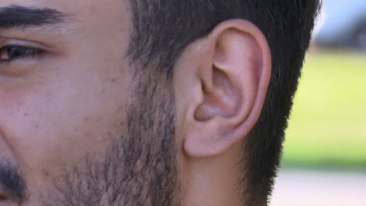 Asker uğurlamasında elinde meşale patlayınca yaralandı