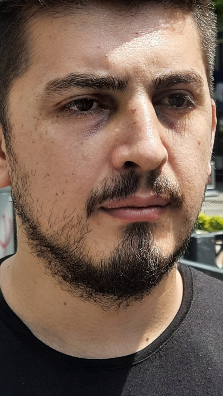 Hastanede hemşirenin burnunu kırdı, adli kontrolle serbest kaldı