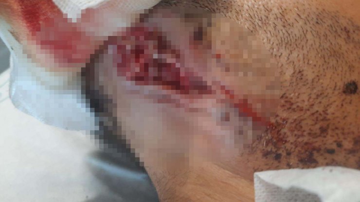 Küçükçekmece'deki pitbullu saldırı: Kulağını kaybetme ihtimali yüzde 90