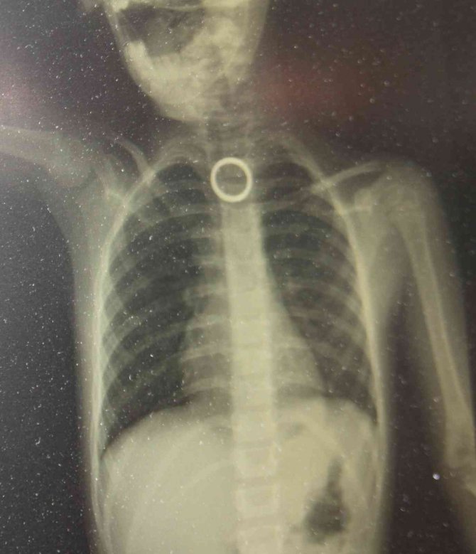 Oyun oynarken yerdeki yüzüğü yutan 3 yaşındaki çocuk ölümden döndü