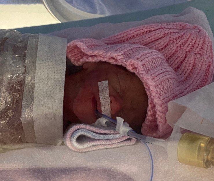 540 gramlık parmak bebek Rabia'yı kök hücre tedavisi hayata bağladı