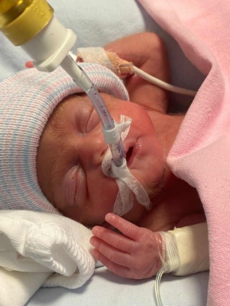 540 gramlık parmak bebek Rabia'yı kök hücre tedavisi hayata bağladı