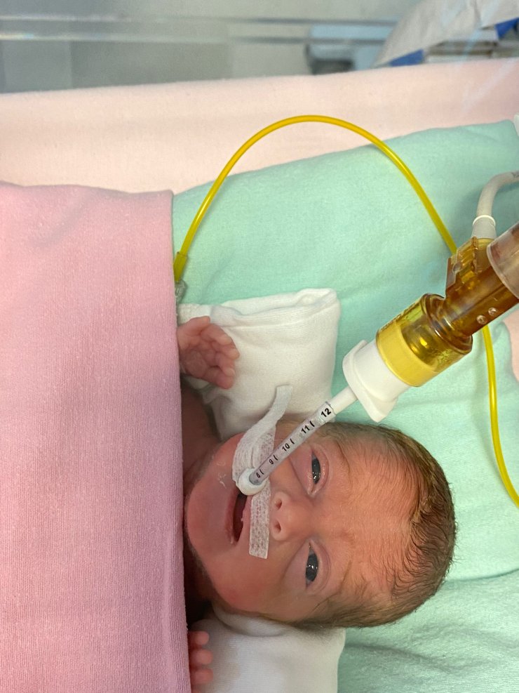 540 gramlık parmak bebek Rabia'yı kök hücre tedavisi hayata bağladı