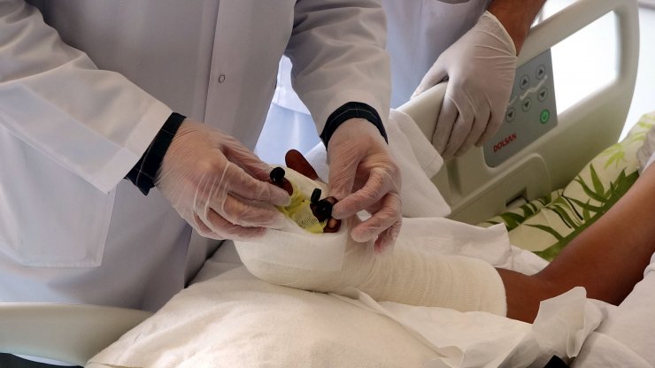 Kopan parmaklarını poşetle hastaneye götürdü, 12 saatte dikildi