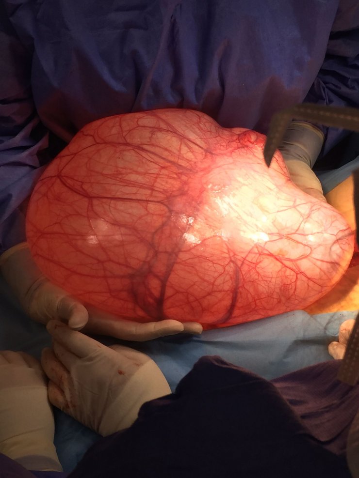 Otobüs çarptı, kaldırıldığı hastanede karnından 7 kilo kitle çıkartıldı