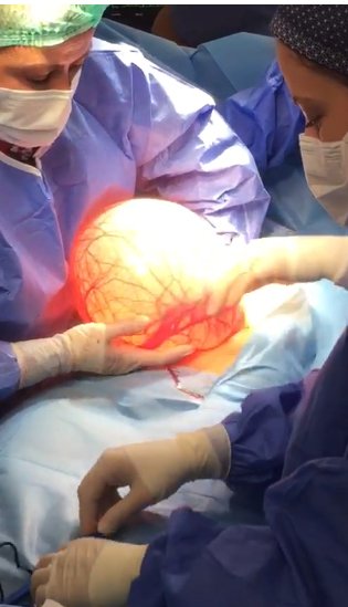 Otobüs çarptı, kaldırıldığı hastanede karnından 7 kilo kitle çıkartıldı