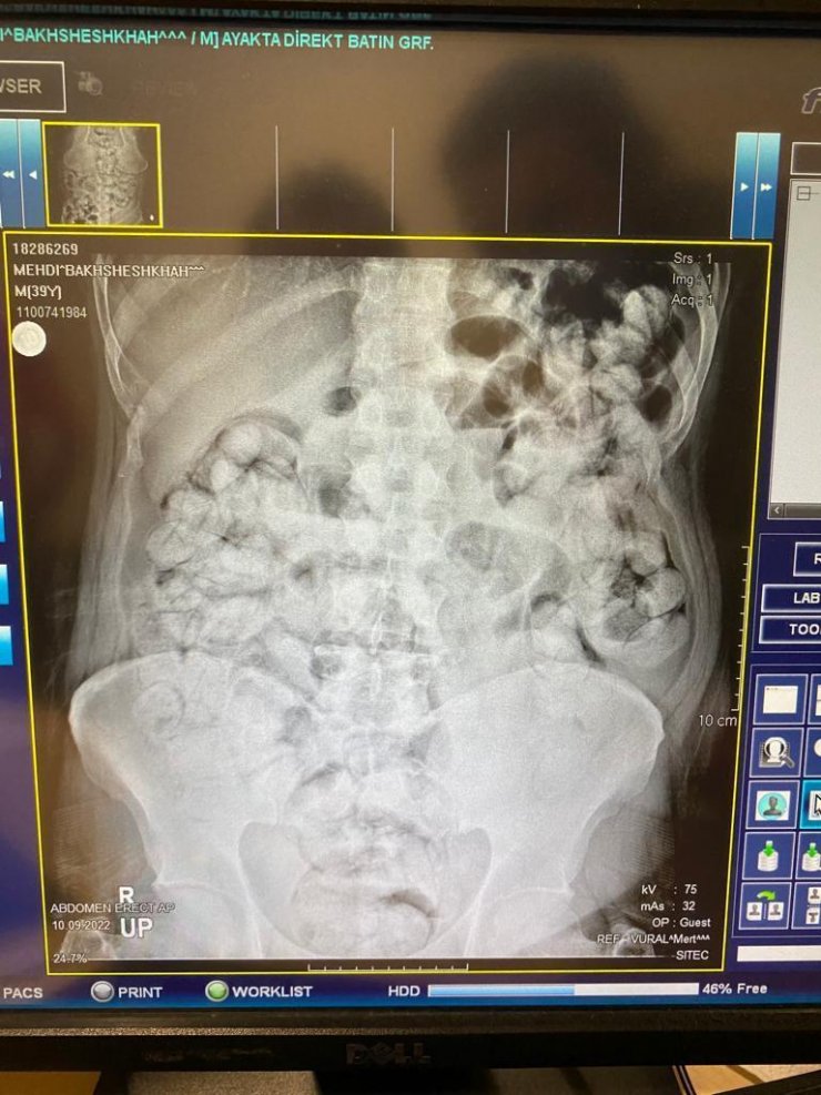 5 şüphelinin midelerinden uyuşturucu çıktı
