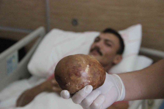 Şaşırtan vaka! Hastaneye başvuran hastanın mesanesinden 1 kilo taş çıktı