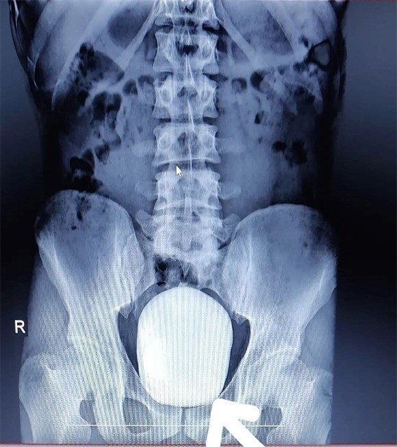Şaşırtan vaka! Hastaneye başvuran hastanın mesanesinden 1 kilo taş çıktı