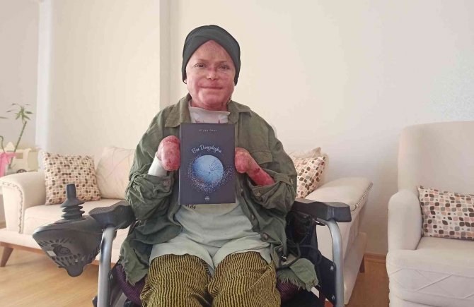 Kelebek hastası Büşra günlüklerini kitap haline getirdi