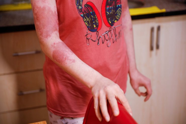 Eski elti dehşeti: 17 kez bıçaklayıp, üzerine kaynar su döktü