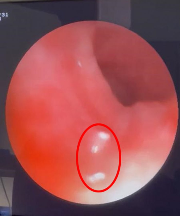 Nefes borusundan canlı sinek larvaları çıktı