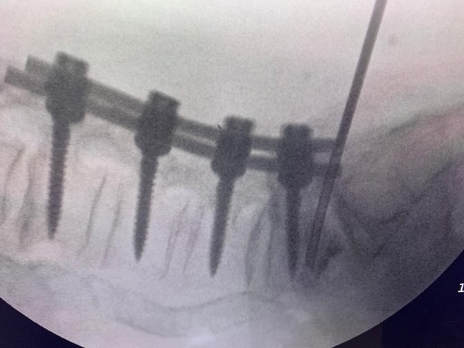 Ameliyata gerek kalmıyor! Türk doktor, bulduğu yöntemle literatüre girdi