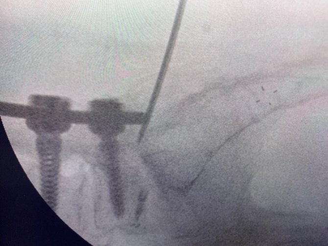 Ameliyata gerek kalmıyor! Türk doktor, bulduğu yöntemle literatüre girdi