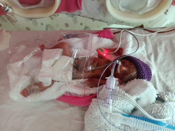 Aren öldü, ikizi Arden 130 gün sonra hayata tutundu