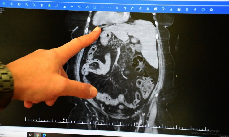 İç organları ters hastaya 'nadir' rastlanan safra operasyonu