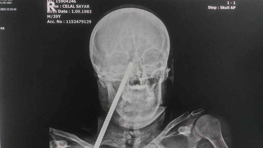 Yüzüne saplanan demirle hastaneye kaldırıldı