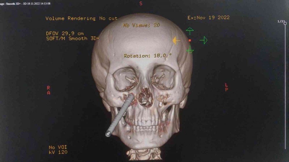 Yüzüne saplanan demirle hastaneye kaldırıldı