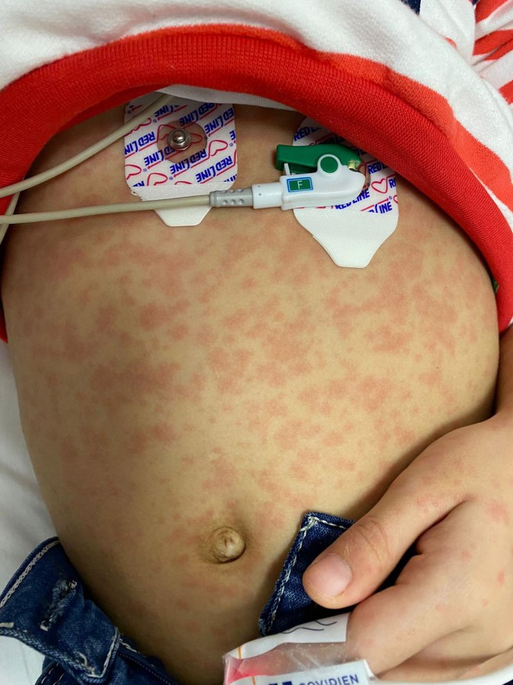 Pandemi etkili oldu, yıllardır görülmeyen vakalar yeniden ortaya çıktı