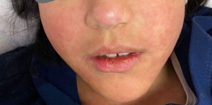 Pandemi etkili oldu, yıllardır görülmeyen vakalar yeniden ortaya çıktı