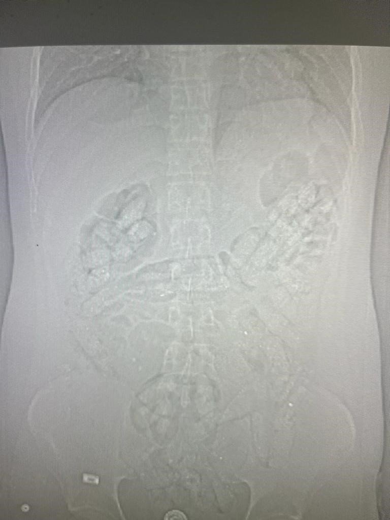 Midesinde uyuşturucu sevkiyatı yaptı!