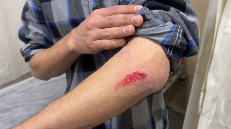 Otobüs beklerken köpeklerin saldırısına uğradı