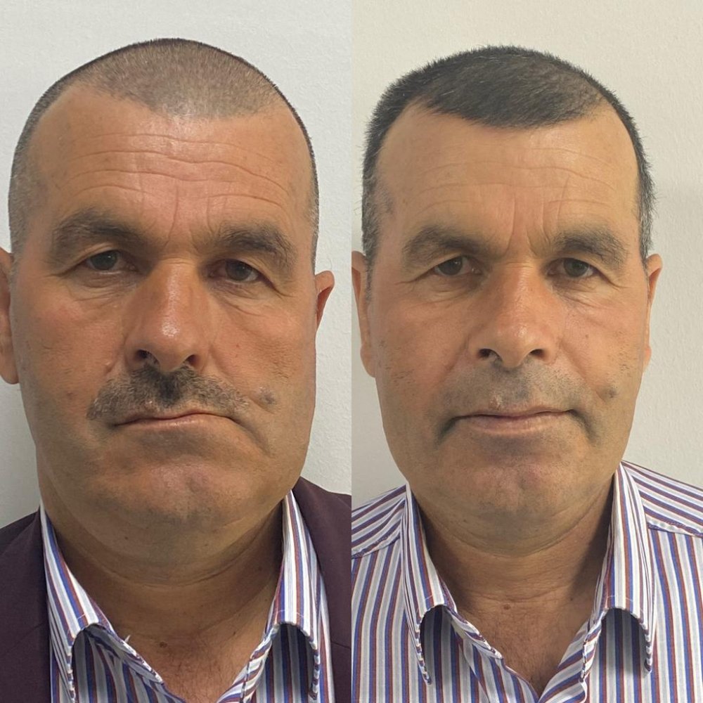 Konya'da 2 hastadaki sebebi bilinmeyen ağrı ve yüz bozulmasının nedeni belli oldu