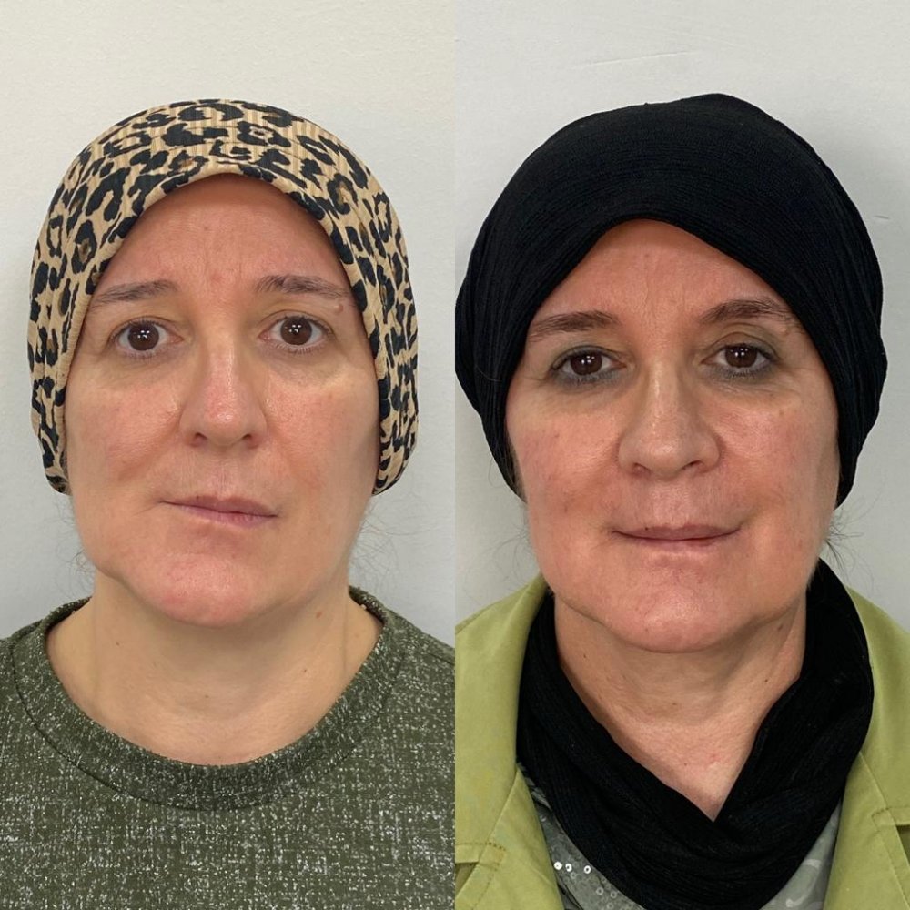 Konya'da 2 hastadaki sebebi bilinmeyen ağrı ve yüz bozulmasının nedeni belli oldu