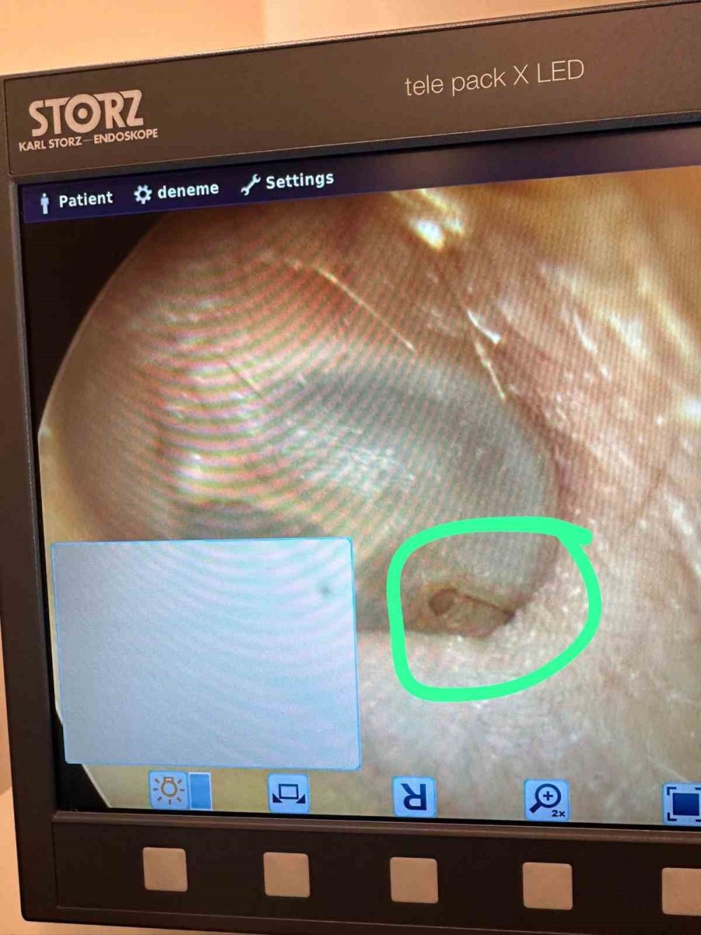 Saç ekerken kulak zarını biçti