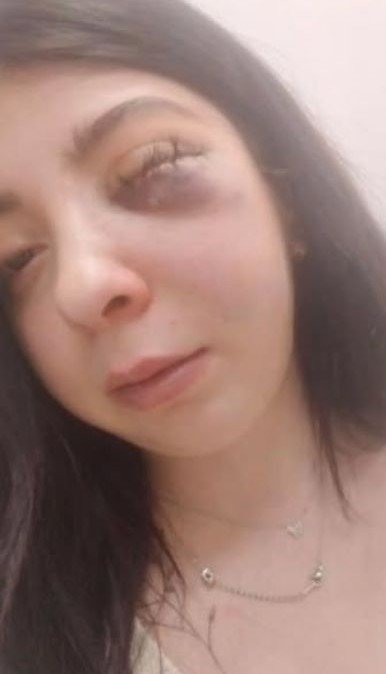 Sokak ortasında darbedildi... Artık yüzümün sol tarafını hissetmiyorum